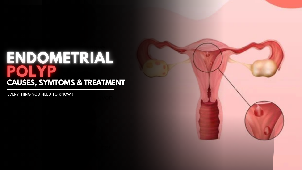 Understanding Endometrial Polyp in Woman: Causes, Symptoms, and Treatment Options